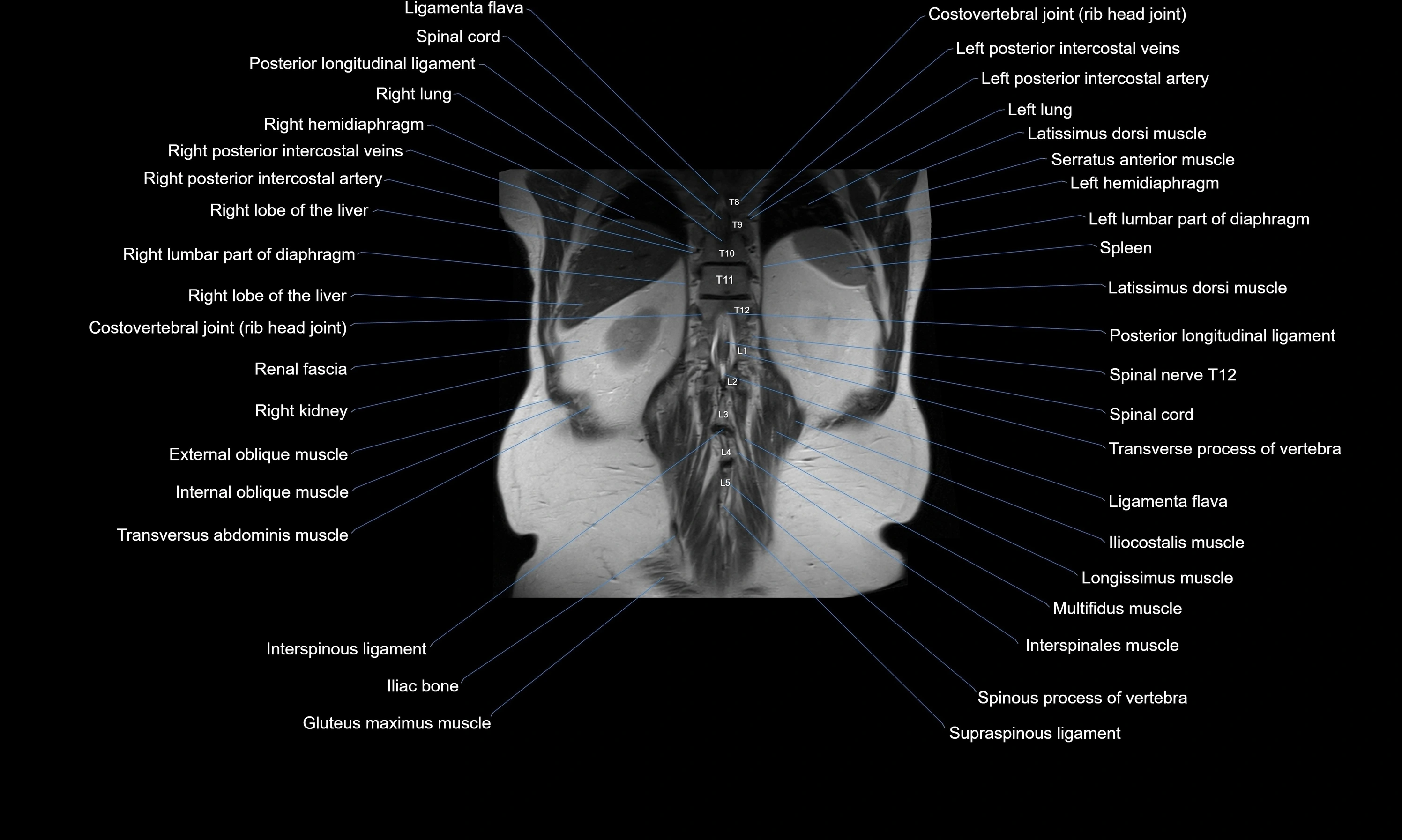 MRI Abdomen axial cross sectional anatomy radiology  image-img-00001-00048.webp